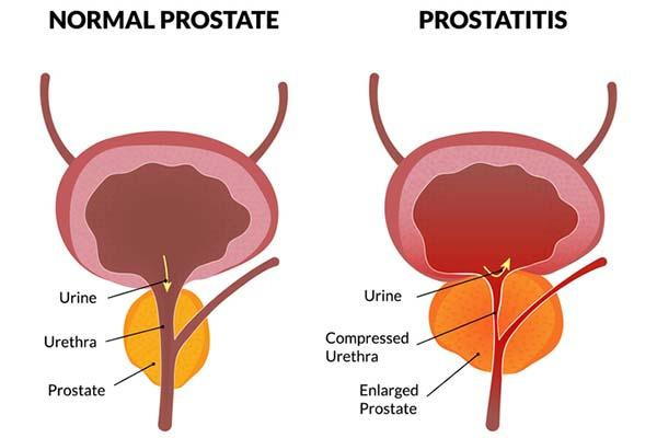 Illustration showing a normal prostate gland on the left and a prostate with prostatitis on the right, with the enlarged gland causing a compressed urethra.